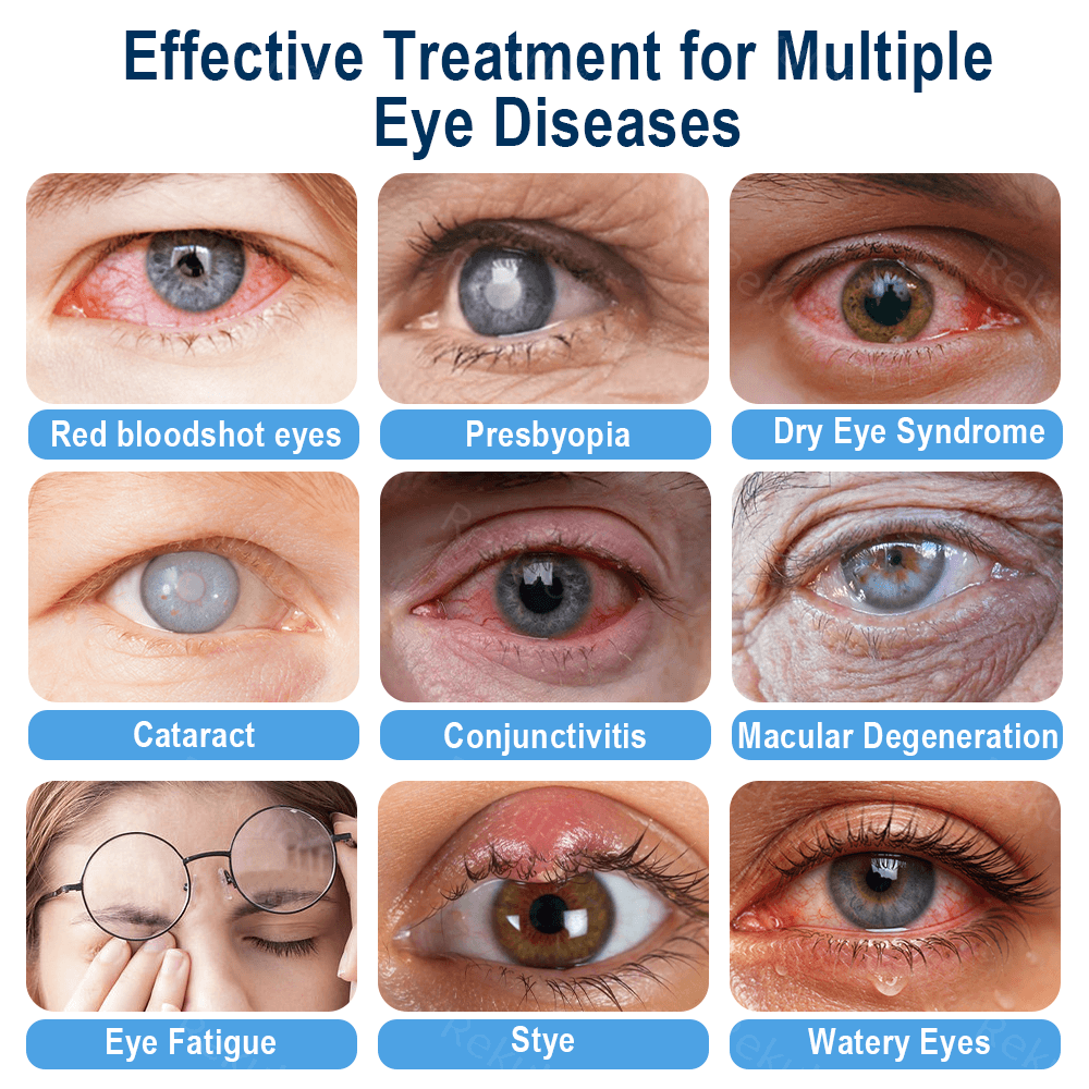 Rekulo® OptiMist Eye Spray✅FDA Approved (For dry eyes, blurry vision, eye strain, presbyopia, and cataracts) 👀☘️