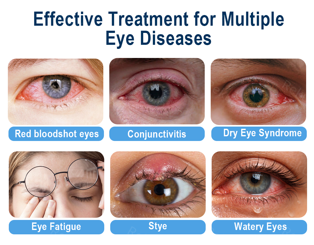 Rekulo® OptiMist Eye Spray✅FDA Approved (For dry eyes, blurry vision, eye strain, presbyopia, and cataracts) ☘️