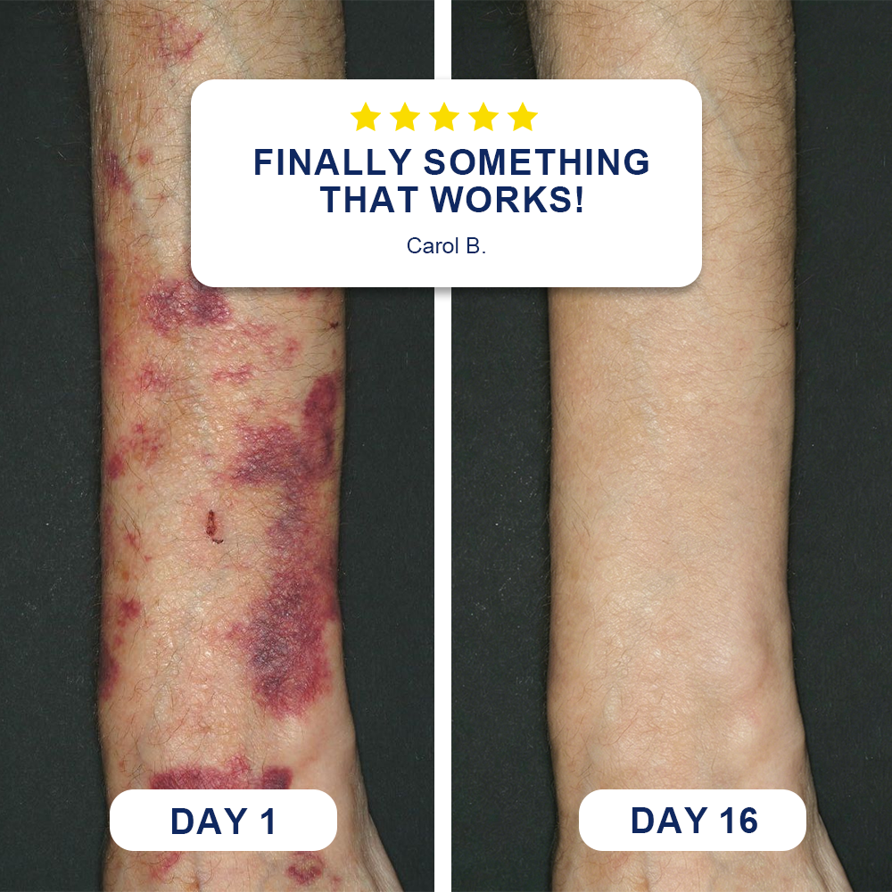 💥100K+ SOLD💕Evolvion® Bruise Repair & Skin-Strengthening Cream up
