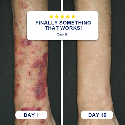💥100K+ SOLD💕Evolvion® Bruise Repair & Skin-Strengthening Cream up