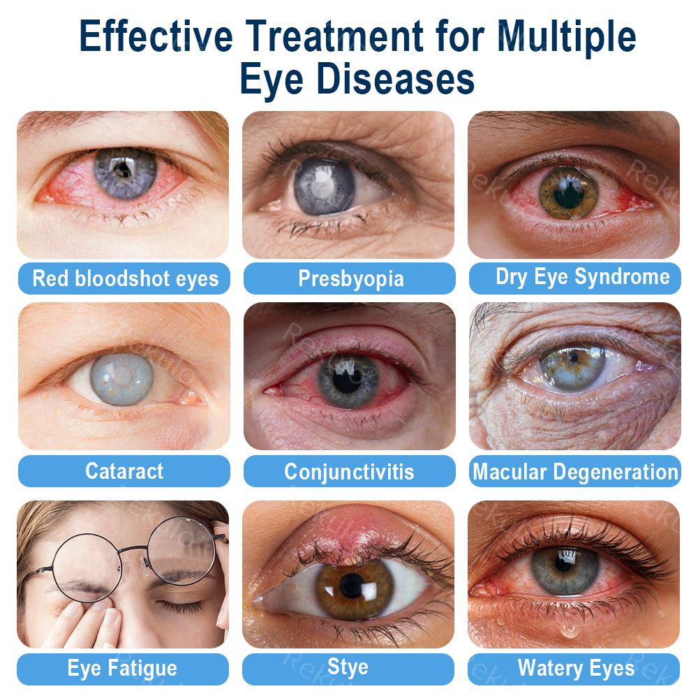 Rekulo® OptiMist Eye Spray✅FDA Approved (For dry eyes, blurry vision, eye strain, presbyopia, and cataracts) 👀