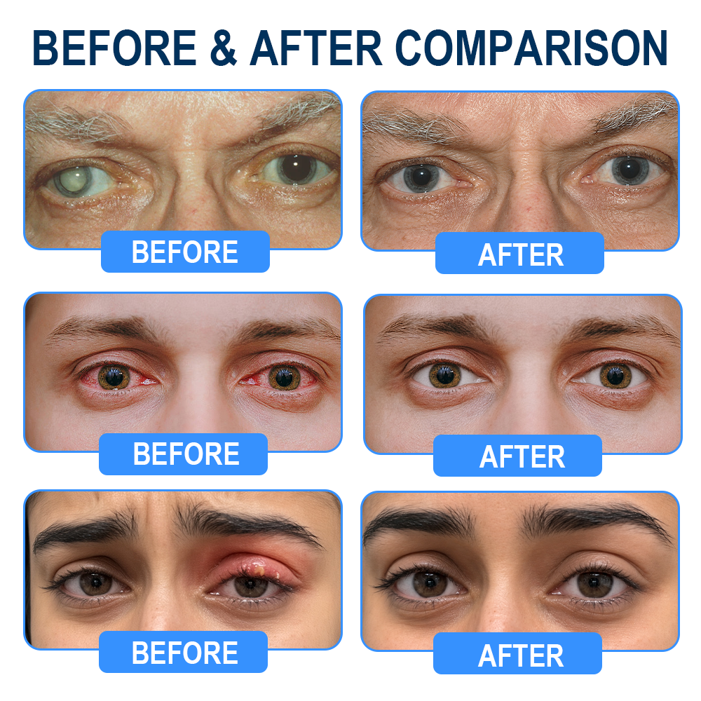 Rekulo® OptiMist Eye Spray✅FDA Approved (For dry eyes, blurry vision, eye strain, presbyopia, and cataracts)👀👀