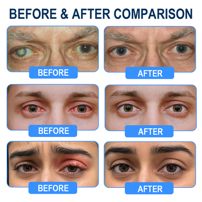 Rekulo® OptiMist Eye Spray✅FDA Approved (For dry eyes, blurry vision, eye strain, presbyopia, and cataracts)👀👀