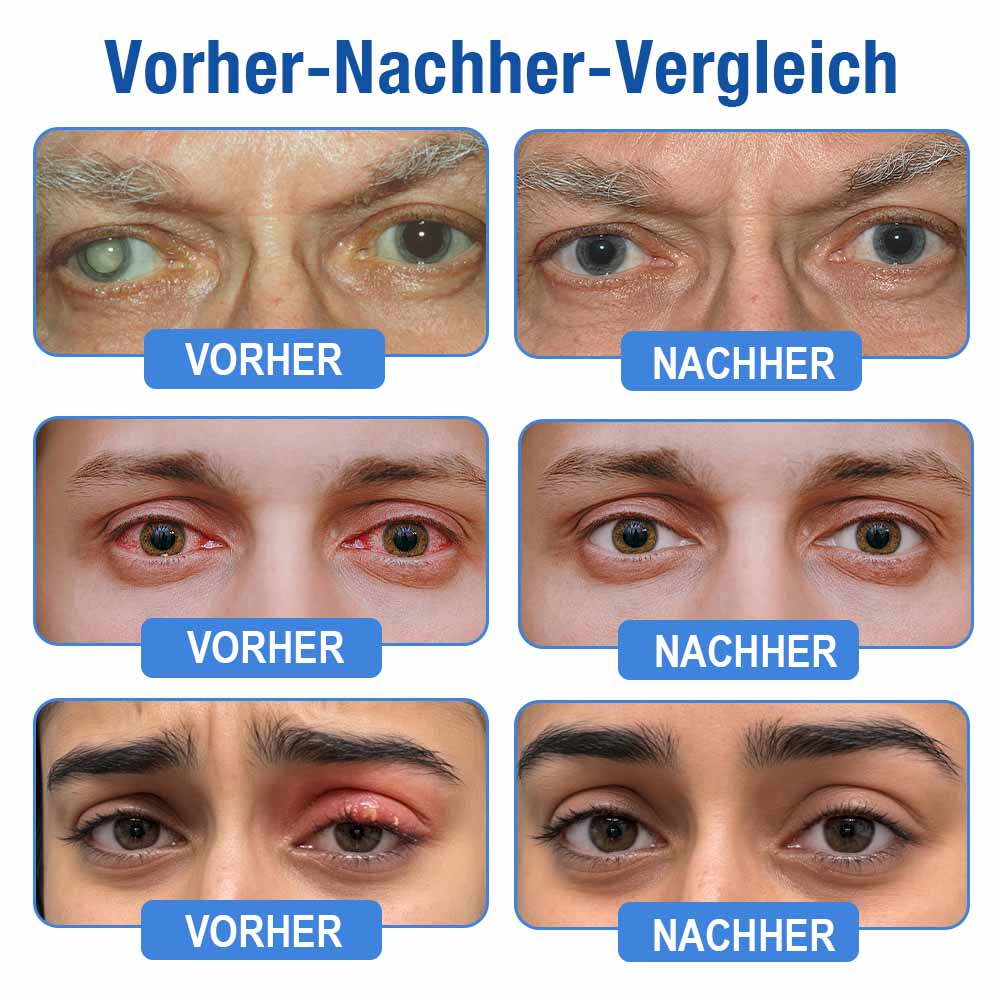 👨‍⚕️ DR.Fachmer® LensClarity Eye Drops✅FDA Approved (For dry eyes, blurry vision & presbyopia) 👀