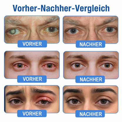 👨‍⚕️ DR.Fachmer® LensClarity Eye Drops✅FDA Approved (For dry eyes, blurry vision & presbyopia) 👀