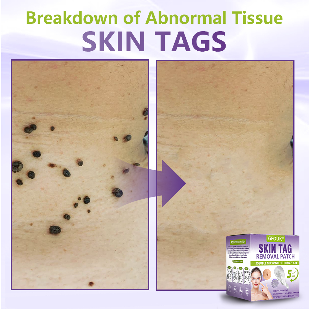 GFOUK® Soluble Microneedle Botanical Skin Tag Removal Patch